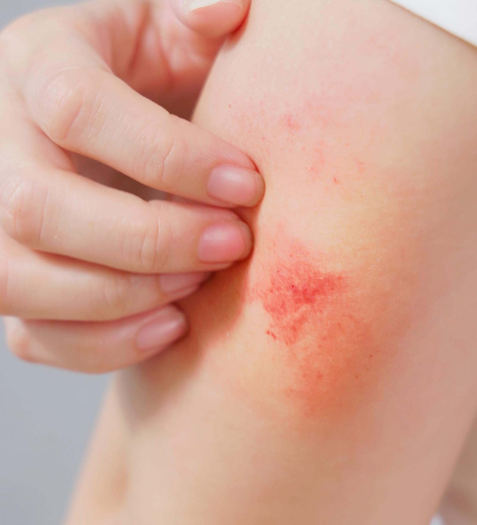 환절기에 심해지는 아토피, ‘피부 보호막’이 관리 기본